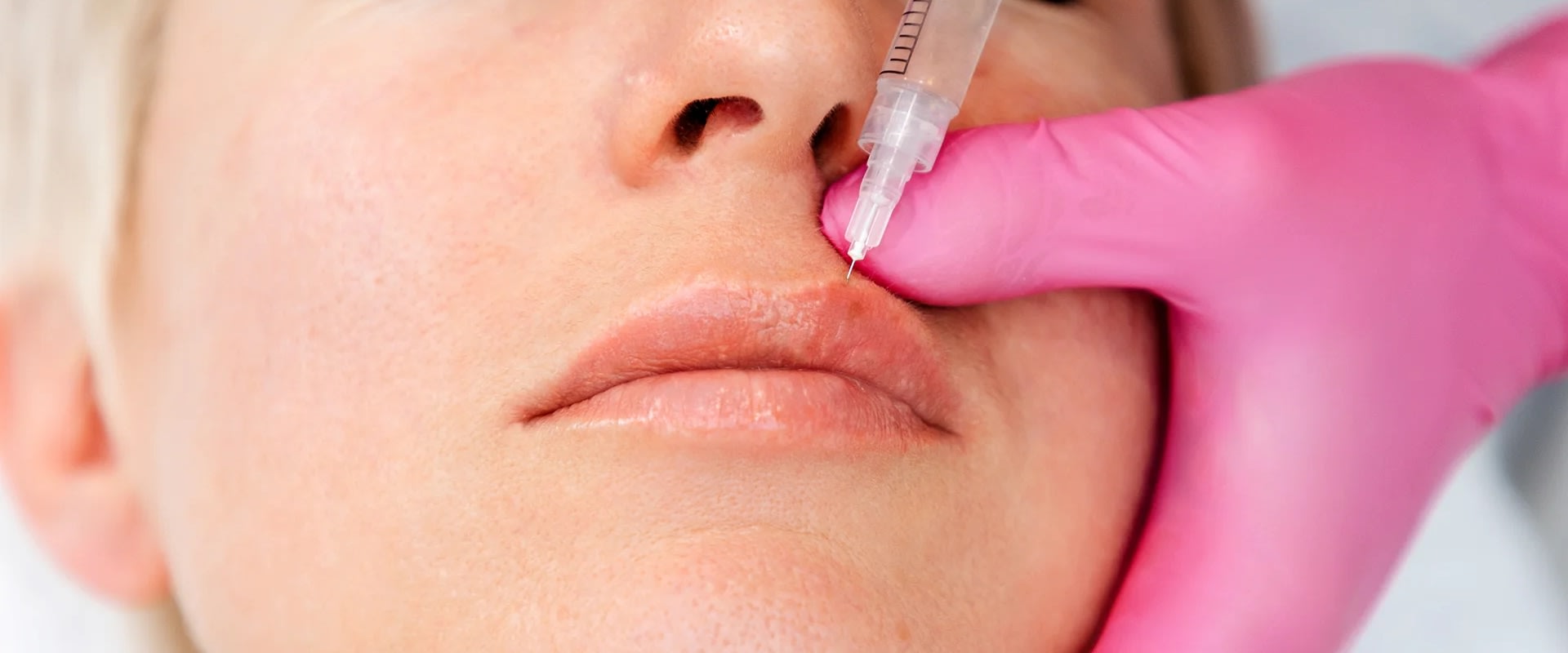A Comprehensive Overview of Dermal Fillers